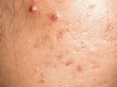 Acne Control
